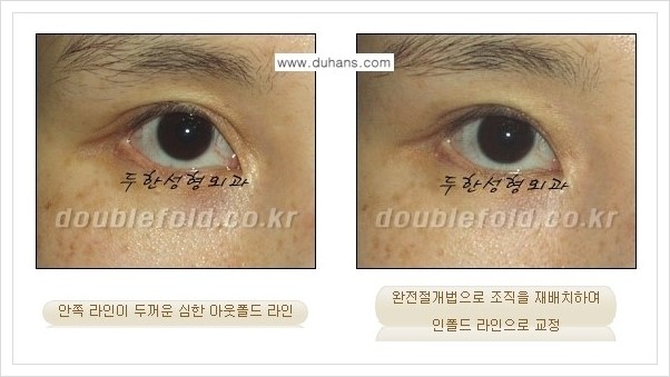 [두한성형외과 경쟁력 쌍꺼풀(눈) 재수술] - [심한 아웃폴드 라인을 인폴드 라인으로의 교정 안내] 관련 이미지 11