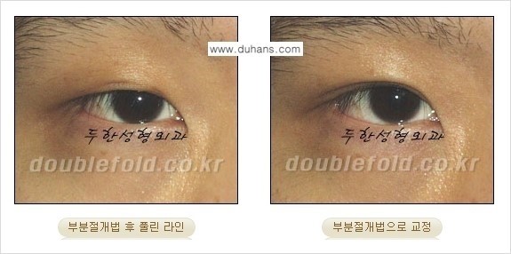 [두한성형외과 경쟁력 쌍꺼풀 재수술, 극한 눈재수술] - [풀린 쌍꺼풀의 완전절개법, 부분절개법 재수술 방법 안내] 관련 이미지 7