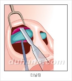 DuHan Plastic Surgery Revision Rhinoplasty - AlloDerm Nose Surgery, SureDerm Nose Surgery image 9