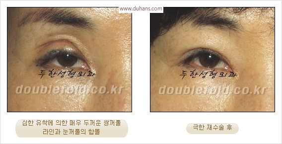 [두한성형외과 경쟁력 눈성형] - [극한 재수술, 함몰된 눈꺼풀 라인교정, 안검하수(졸리운 눈매)] 관련 이미지 4