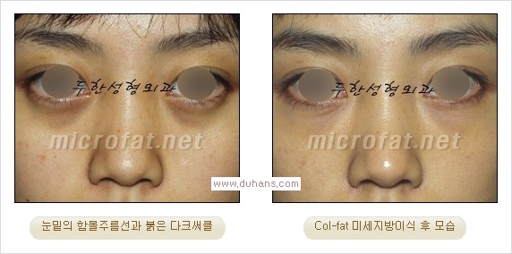 [두한성형외과 경쟁력 눈밑성형] - [눈밑 미세지방이식으로 다크써클 치료] 관련 이미지 14