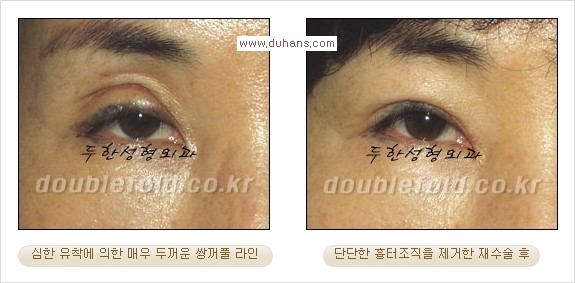 [두한성형외과 경쟁력 쌍꺼풀 재수술, 극한 재수술] - [쌍꺼풀 재수술에서 극복해야 할 극한의 상황과 문제들] 관련 이미지 6