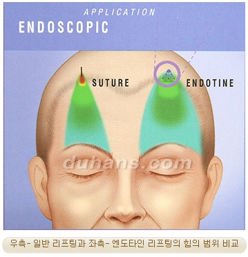 두한성형외과 안티에이징 리프팅 - 엔도타인 리프팅 관련 이미지 19