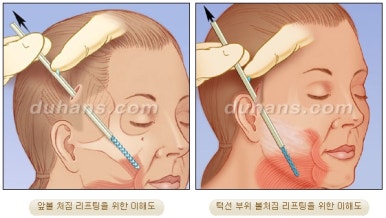 [Duhan Plastic Surgery Wrinkle Improvement] - [Wrinkle Lifting] image 16