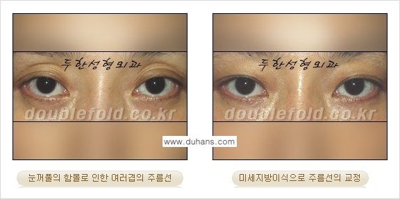 [두한성형외과 경쟁력 눈성형] - [미세지방이식으로 삼중 라인의 교정 방법 안내] 관련 이미지 4