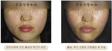 Facial Fat Liposuction at Duhan Plastic Surgery - Cheek Fat Liposuction, Jawline Liposuction, Under-Eye Fat Liposuction image 13
