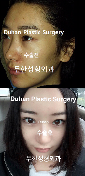 뒤,밑트임 후기 관련 이미지 1