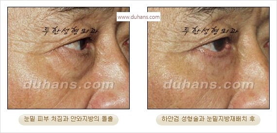 [두한성형외과 경쟁력 안검성형] - [눈밑주름 제거수술] 관련 이미지 25