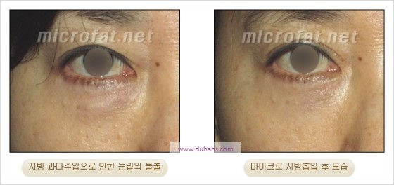 [두한성형외과 경쟁력 지방이식] - [두한 자가지방이식 클리닉 안내]​ 관련 이미지 88
