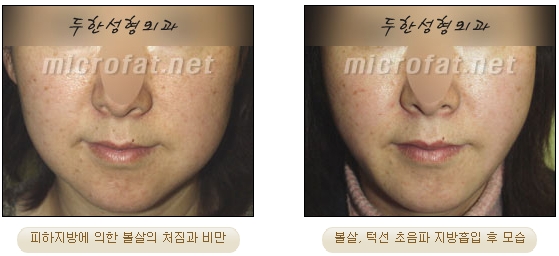[Duhan Plastic Surgery Liposuction] - [Facial Liposuction] image 12