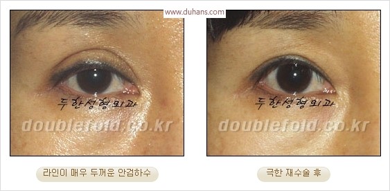 [두한성형외과 경쟁력 눈성형] - [극한 재수술, 함몰된 눈꺼풀 라인교정, 안검하수(졸리운 눈매)] 관련 이미지 27