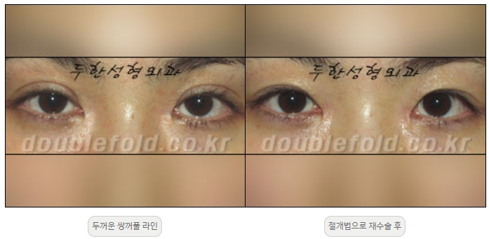 [Duhan Plastic Surgery Double Eyelid Revision] - [Thick Double Eyelid Line] image 10
