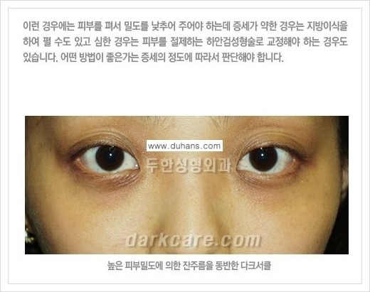 [두한성형외과 경쟁력 다크써클 교정] - [다크써클의 원인 안내] 관련 이미지 9