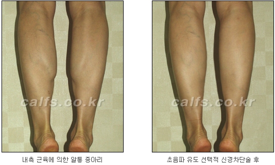 [두한성형외과 종아리퇴축술] - [NO절개! 초음파유도신경차단술] 관련 이미지 25