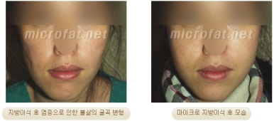 [두한성형외과 지방이식] - [지방이식 부작용 종류와 문제점] 관련 이미지 22