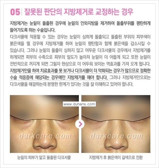 [두한성형외과 경쟁력 눈밑성형] - [다크써클 치료 실패의 원인 안내 ②] 관련 이미지 4
