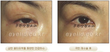 Duhan Plastic Surgery Ophthalmic Reoperation - What Is a Successful Double Eyelid Revision Surgery? image 21
