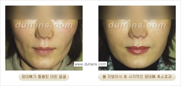 [두한성형외과 경쟁력 미세지방이식] - [볼살, 이마, 측두부 - 안면윤곽 미세지방이식] 관련 이미지 10