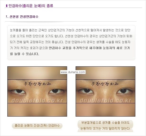 [두한성형외과 경쟁력 눈성형] - [안검하수(졸린 눈매) 재수술 안내 ①] 관련 이미지 3