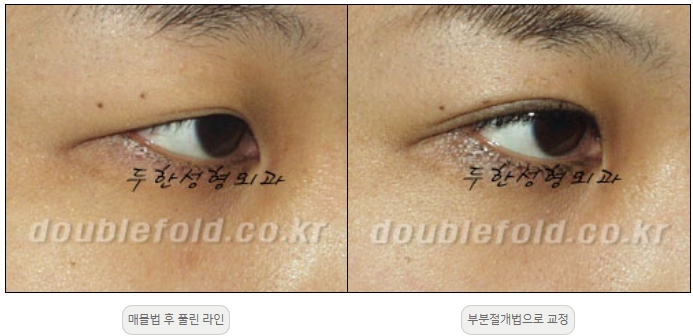 [두한성형외과 쌍커풀재수술] - [풀린 쌍커풀라인 교정] 관련 이미지 10