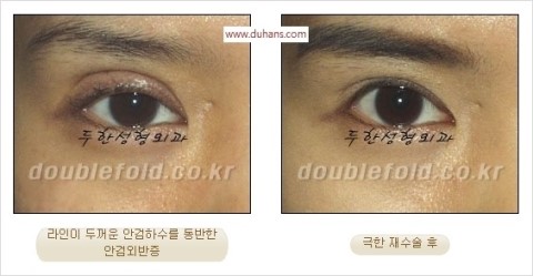 ​[두한성형외과 눈재수술] - [앞트임복원, 뒤트임복원, 쌍꺼풀복원] 관련 이미지 37
