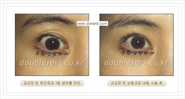 [두한성형외과 경쟁력 쌍꺼풀 재수술, 극한 재수술] - [과한 눈매교정 안내] 관련 이미지 2