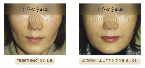 [두한성형외과 경쟁력 지방이식 리더] - [Col-fat(콜펫)지방이식, 3차원 입체지방이식, 2차원 평면지방이식] 관련 이미지 53