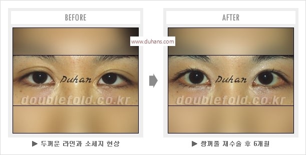 [두한성형외과 경쟁력 눈성형] - [나에게 맞는 어울리는 쌍꺼풀 라인] 관련 이미지 26