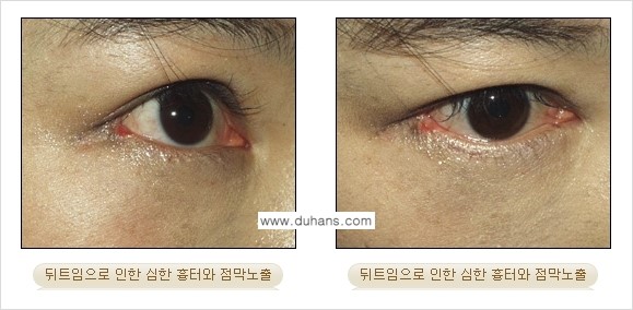 [두한성형외과 NO.1 눈성형] - [뒤트임 수술에 대한 정보] 관련 이미지 12