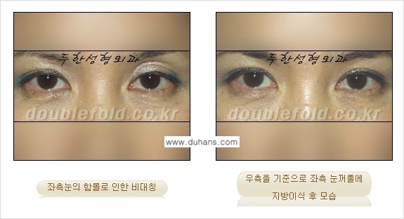 [두한성형외과 경쟁력 쌍꺼풀 재수술] - [비대칭(짝짝이) 쌍꺼풀 라인 교정하는 방법 안내 ②] 관련 이미지 11