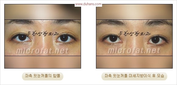 [두한성형외과 경쟁력 눈성형 리더] - [윗눈꺼풀 함몰( #꺼진눈꺼풀) 미세지방이식과 상안검성형]#꺼진눈성형 , #눈위함몰 관련 이미지 37