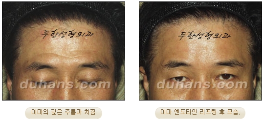 두한성형외과 안티에이징 리프팅 - 엔도타인 리프팅 관련 이미지 27