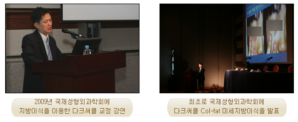 [두한성형외과 지방이식] - [다크서클, 눈밑주름] 관련 이미지 3