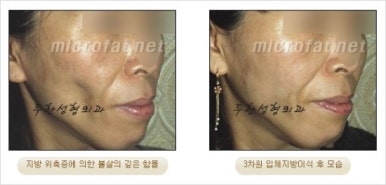 [두한성형외과 얼굴자가지방이식] - [지방이식 과정] 관련 이미지 40