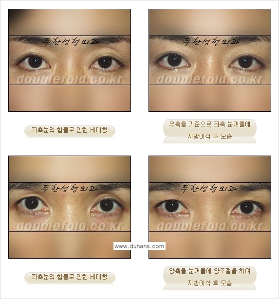 [두한성형외과 경쟁력 눈성형] - [비대칭(짝짝이) 쌍꺼풀 라인 교정 안내 ②] 관련 이미지 10