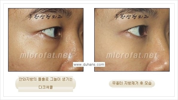 [두한성형외과 경쟁력 눈밑성형] - [눈밑지방제거, 눈위지방제거 안내 2.] 관련 이미지 12