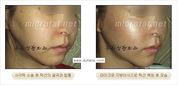 [두한성형외과 경쟁력 미세지방이식] - [타 병원에서 볼살 지방이식 이후 부작용 교정 방법 안내] 관련 이미지 9