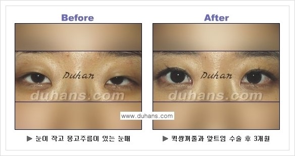 [두한성형외과 경쟁력 쌍꺼풀 재수술, 극한 재수술] - [퀵쌍꺼풀 안내] 관련 이미지 5