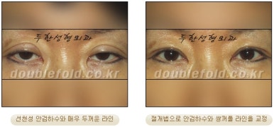 [Duhan Plastic Surgery Double Eyelid Revision Surgery] - [Ptosis, sausage eyelids] image 21