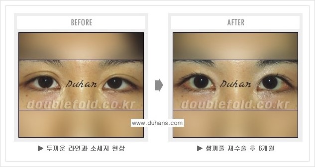 [두한성형외과] - [쌍꺼풀 재수술 푸는 수술을 하고 내원했을 경우의 문제] 관련 이미지 3