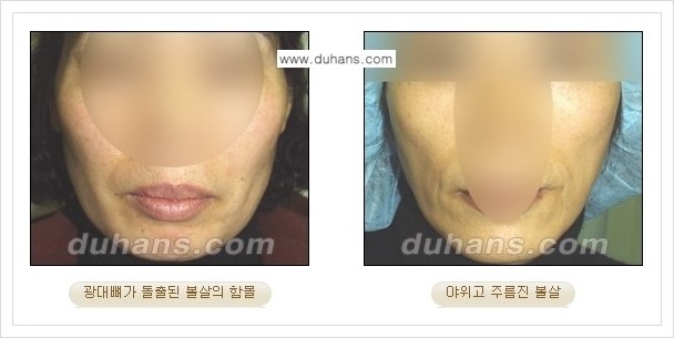 [두한성형외과 경쟁력 얼굴미세지방이식] - [볼살지방이식, 이마지방이식, 측두부지방이식 안내] 관련 이미지 2
