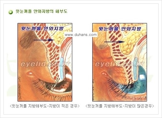 [두한성형외과 경쟁력 눈성형] - [윗눈꺼풀 지방제거 방법 안내] 관련 이미지 2
