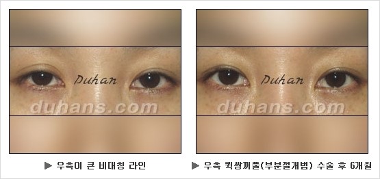 [두한성형외과 쌍커풀수술] - [눈성형 방법에 대한 자주하는 질문과 답변] 관련 이미지 122