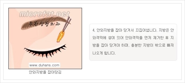 [두한성형외과 경쟁력 지방제거] - [눈밑지방제거, 눈위(윗눈꺼풀)지방제거 안내] 관련 이미지 8