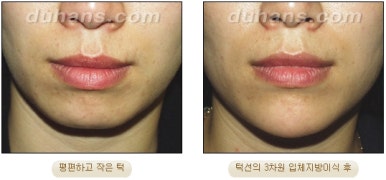 [Duhan Plastic Surgery Micro Fat Grafting] - [Receded Chin, Small Chin, Cleft Chin, Chin Line Asymmetry Correction] image 13