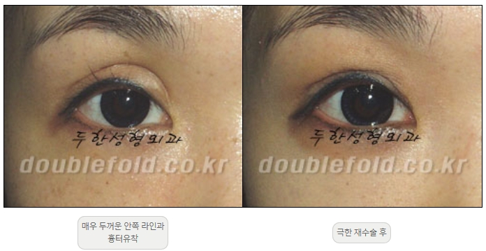 [Double Eyelid Surgery, Duhan Plastic Surgery] - [Extreme Revision Eye Surgery to Correct a Damaged Line] image 13