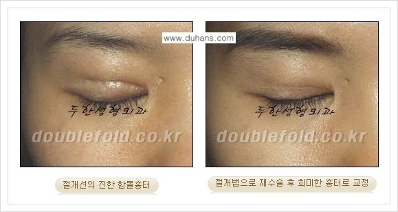 [두한성형외과 경쟁력 쌍꺼풀(눈) 재수술] - [쌍꺼풀 흉터선이 진한 경우의 안내] 관련 이미지 5