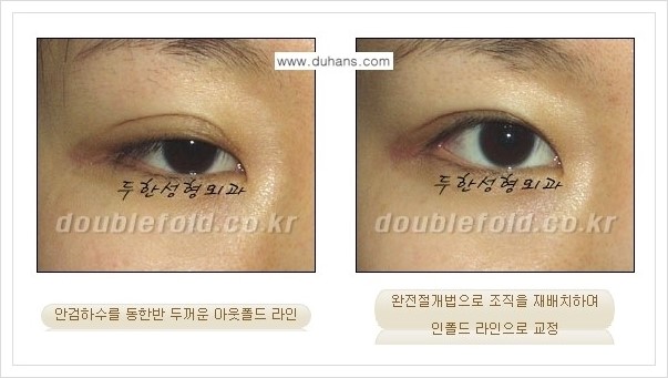 [두한성형외과 경쟁력 쌍꺼풀(눈) 재수술] - [심한 아웃폴드 라인을 인폴드 라인으로의 교정 안내] 관련 이미지 3
