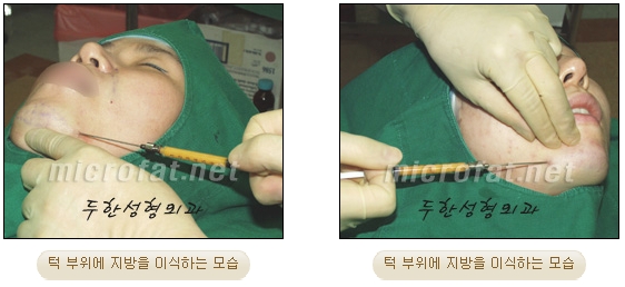 [두한성형외과 미세지방이식] - [무턱교정 안내] 관련 이미지 12