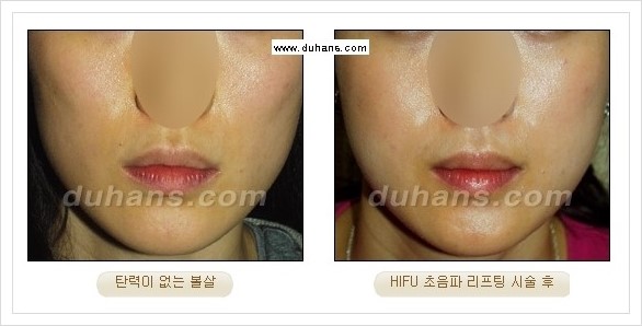 [두한성형외과 경쟁력 주름성형] - [HIFU 초음파 리프팅 주름교정술 안내 2.] 관련 이미지 22